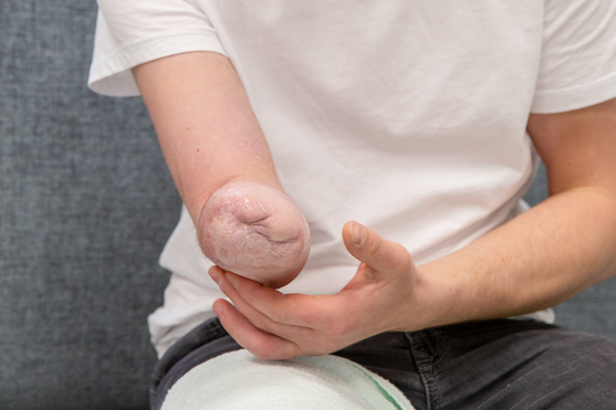 Amputation des Unterarms | © Pohlig GmbH