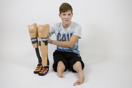 Femur-Fibula-Ulna-Syndrom (FFU-Syndrom) | © Pohlig GmbH