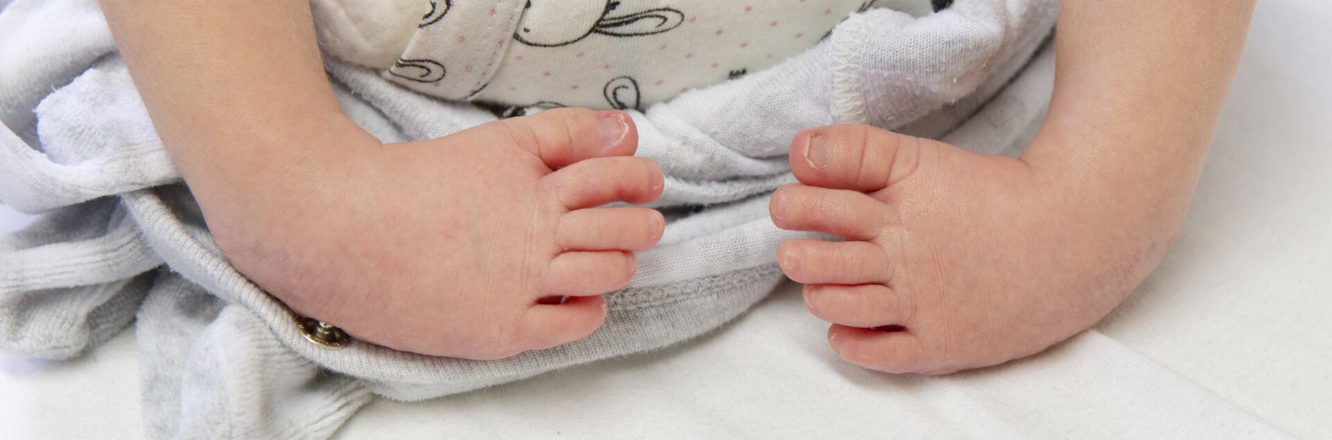 Babyfuß mit Fußfehlstellung. | © Pohlig GmbH