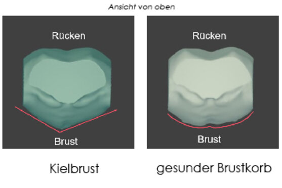 Training kielbrust Checkliste Orthopädie